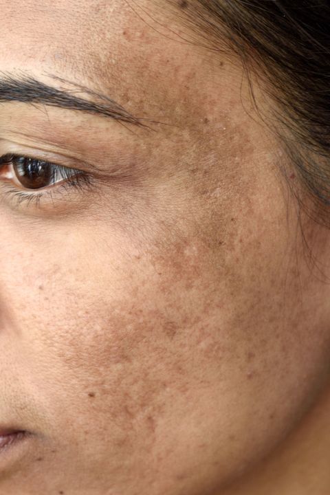 Dark spot