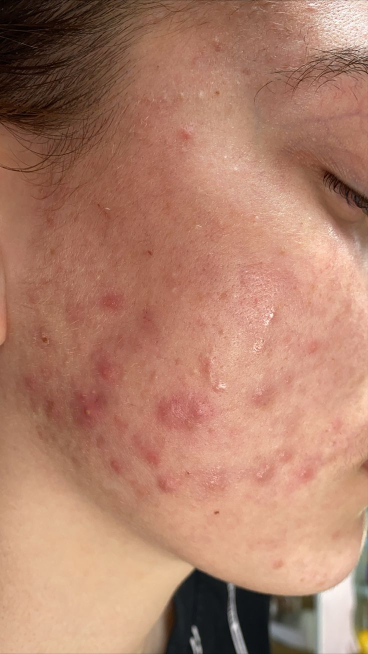 Damaged Skin Barrier