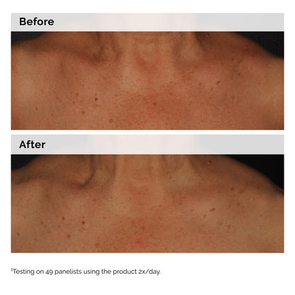 The Ordinary Niacinamide 5% Face and Body Emulsion, Dark Spot & Skin Tone Corrector, 3.4 Fl Oz