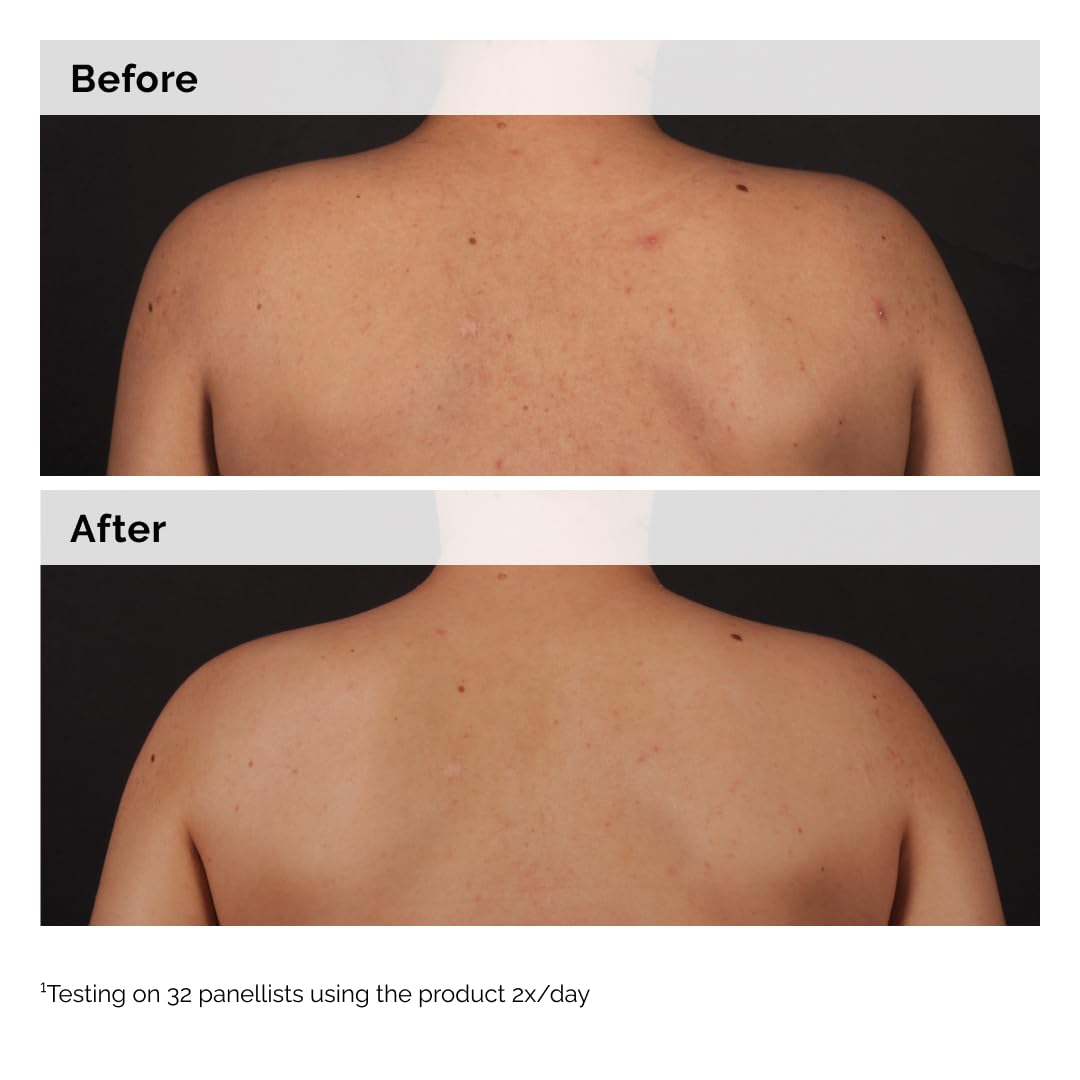 The Ordinary Salicylic Acid 0.5% Body Serum, Exfoliating Treatment for Acne-Prone Skin, 8.1 Fl Oz