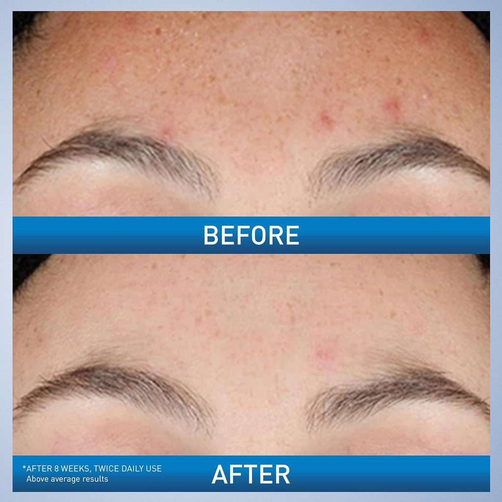CeraVe Resurfacing Retinol Serum – 30 ml | For Post-Acne Marks & Uneven Skin Texture