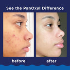 PanOxyl Acne Foaming Wash (for Face & Body) 10 % Benzoyl Peroxide Acne Treatment Wash Maximum Strength 28 g