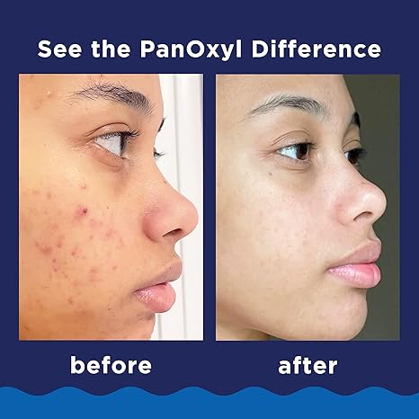 PanOxyl Acne Foaming Wash (for Face & Body) 10 % Benzoyl Peroxide Acne Treatment Wash Maximum Strength