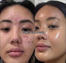 ANUA Niacinamide 10 + TXA 4 Serum, Hyaluronic Acid, Tranexamic acid, Vitamin B12