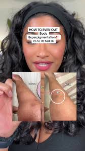 The Ordinary Niacinamide 5% Face and Body Emulsion, Dark Spot & Skin Tone Corrector, 3.4 Fl Oz