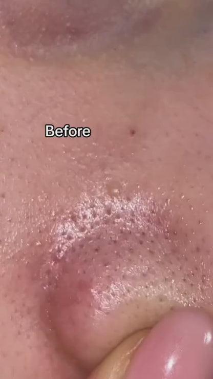 Medicube Zero Pore Pad – Dual-Textured AHA/BHA Toner Pads for Visible Pore Refining