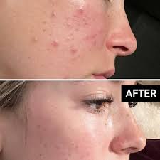 The Ordinary Granactive Retinoid 2% in Squalane 30ml - image 4